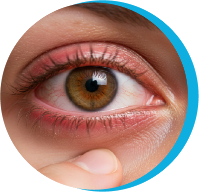 Ojos Que Arden | Oftalmología Boutique - OPTISA